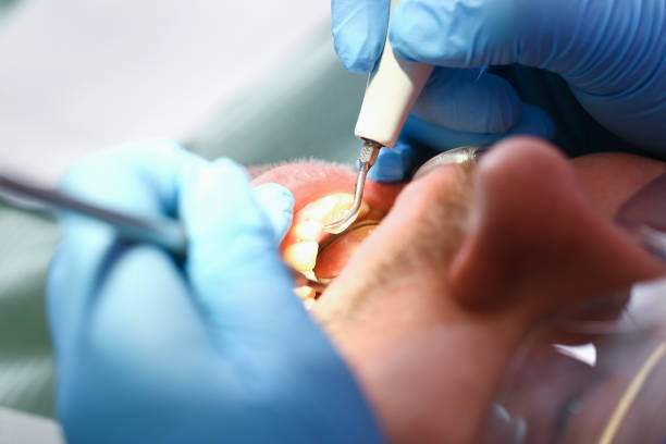Best Emergency Dentist for Lost Fillings or Crowns in Eufaula, AL